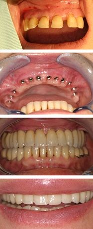 имплантация зубов под ключ с коронкой цена