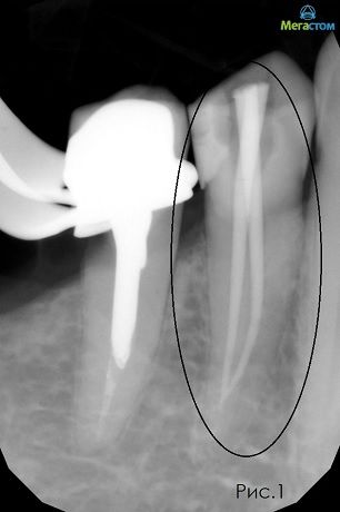сколько болит зуб после пломбирования каналов, методы пломбирования каналов зубов