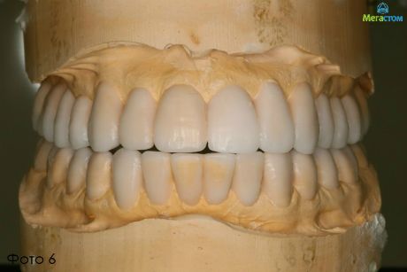 Смоделированная индивидуальная форма зубов пациентки в правильном прикусе 