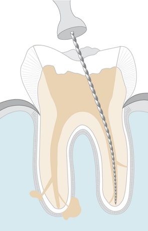 Болит зуб после лечения глубокого кариеса, почему болит зуб после лечения кариеса, как долго болит зуб после пломбирования каналов