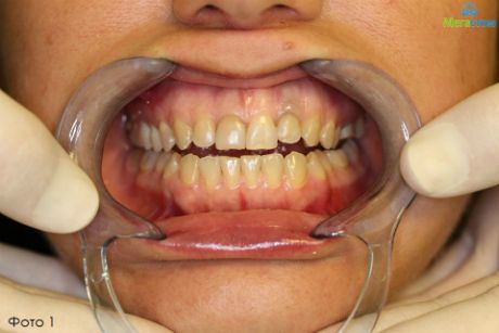 Лечение по принципам нейромышечной стоматологии и гнатологии, исправление прикуса без брекетов у взрослых цена