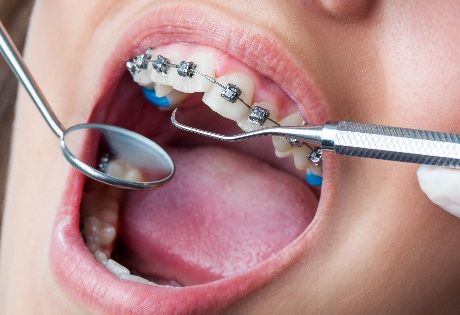 профилактика кариеса при ортодонтическом лечении 