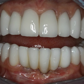 ПОСЛЕ протезирования: расстояние между шейками зубов 12/43 – 19,5 мм