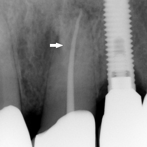 Определено колбовидное расширение корневого канала зуба 2.1
