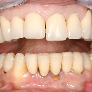 ДО лечения: расстояние между шейками зубов 12/43 – 17,5 мм