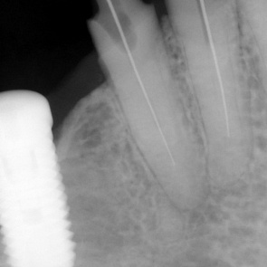 Пломбирование каналов зубов гуттаперчей (штифтами) методом вертикальной конденсации под микроскопом.