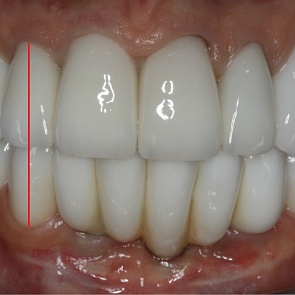 ПОСЛЕ протезирования: расстояние между шейками зубов 12/43 – 19,5 мм