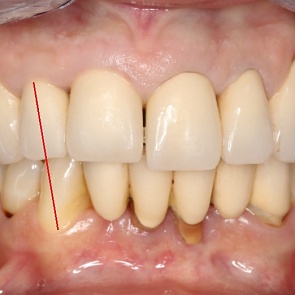 ДО лечения: расстояние между шейками зубов 12/43 – 17,5 мм