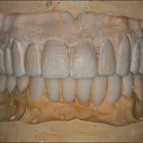 Восковое моделирование зубов